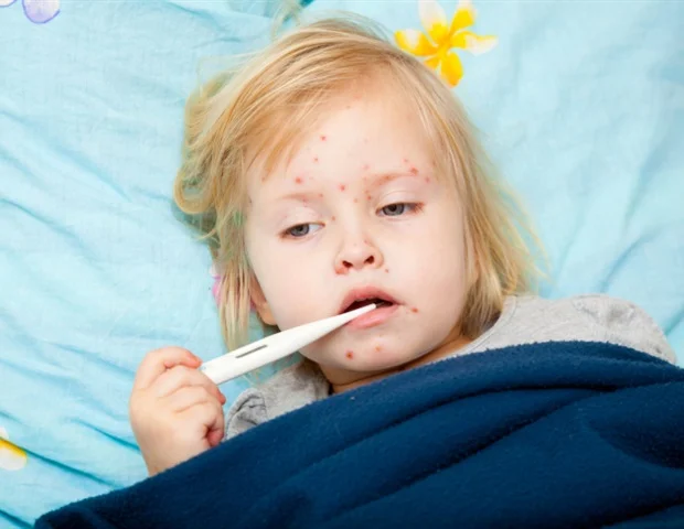 Measles Symptoms, Causes, and Treatment: A Complete Health Guide
